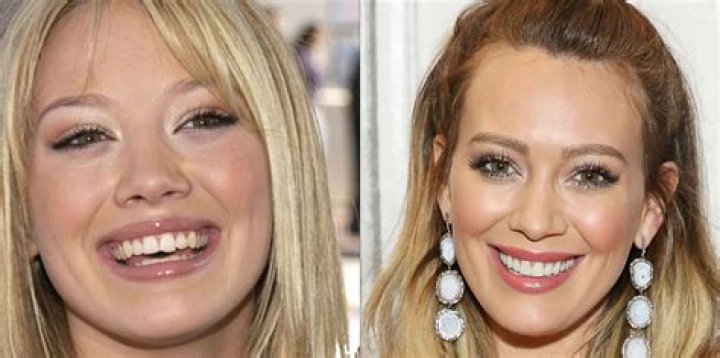 Did Chandlers Teeth Change In Friends? – Celebrity